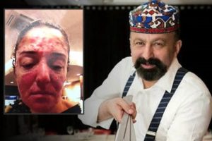 'Ünlü iş adamı yüzüme kimyasal attı' iddiası yalan çıktı