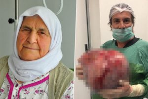 Karnından 12 kiloluk kist çıktı