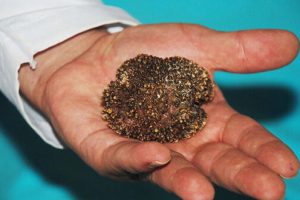 Mesanesinde 220 gramlık taş çıktı