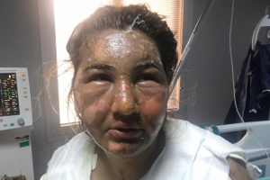 Cezaevinden izinli çıktı, eski eşini yağ ile yaktı