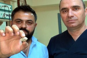 Tükürük bezinden taş çıktı