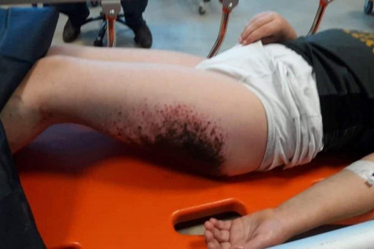 Karla oynarken vücudunda yanık oluşan Berat'a doku nakli yapıldı