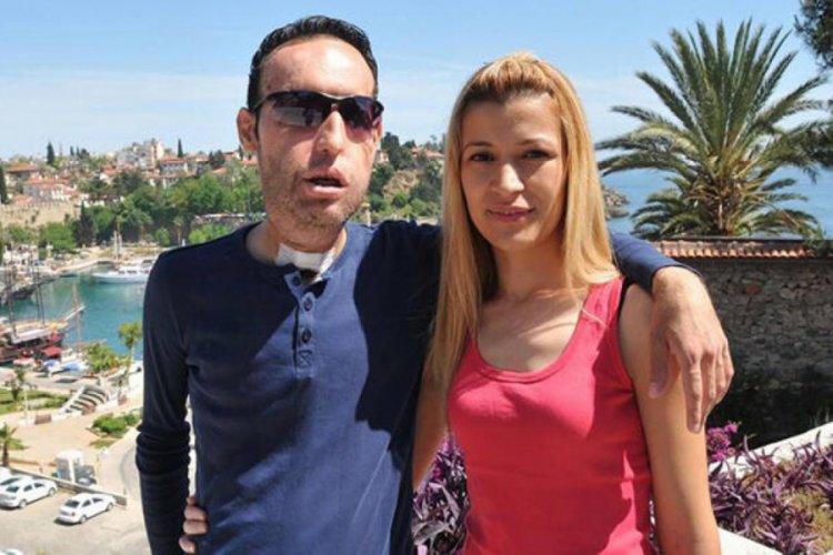 Yüz nakilli Recep Sert ile eşi Esma Sert'ten ayrılık kararı