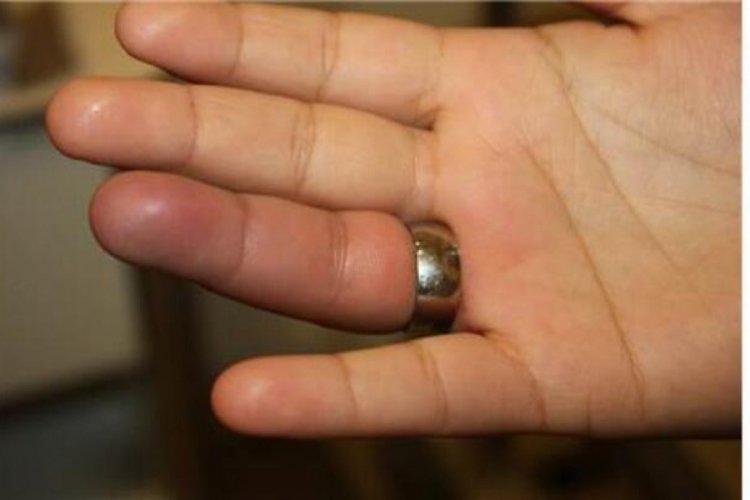 Parmağına sıkışan yüzüğü itfaiye çıkardı