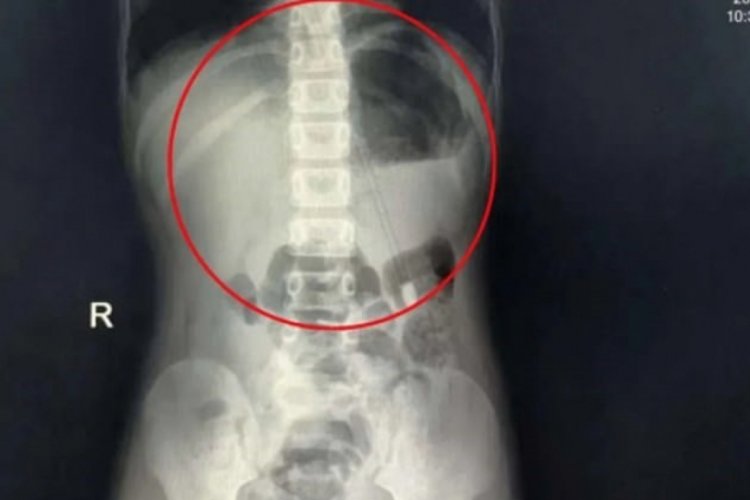 7 yaşındaki çocuğun boğazından 18 cm'lik kalem çıktı