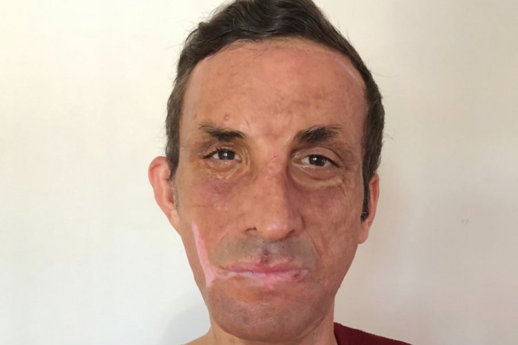 İlk yüz nakilli Uğur Acar: Koronavirüs nedeniyle 3 ay evden çıkmadım