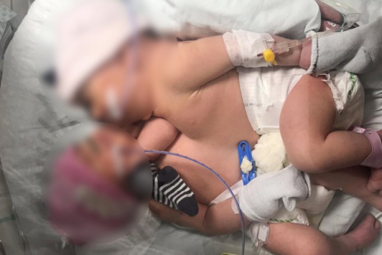 Siyam ikizi bebekler doğumdan 8 gün sonra ayrıldı