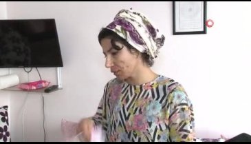 Burun estetiği kabusu oldu