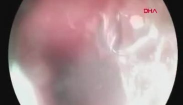 Bursa'da dişçide akciğerine implant parçası kaçtı!