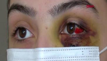 Telefonda video izlediği için kocası bu hale getirdi!