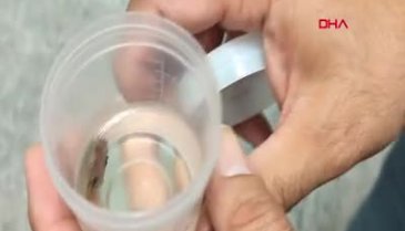 Öksürük şikayetiyle hastaneye giden şahıs akciğerinden çıkanla şaşkına döndü