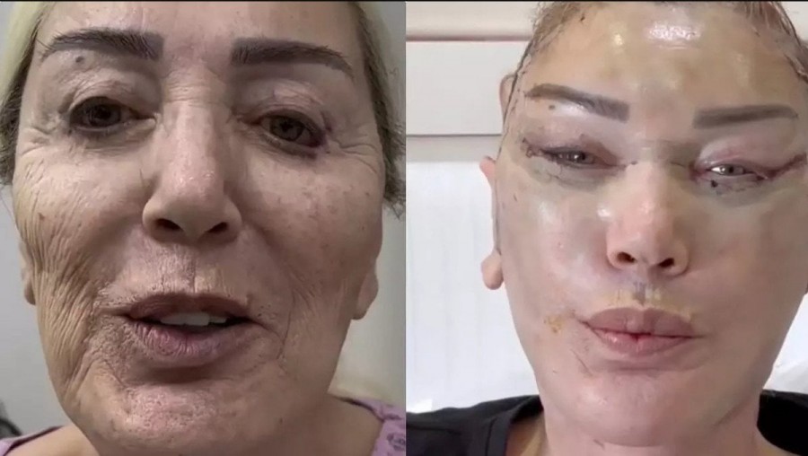 Nursel Sayan da gençleşmek için bıçak altına yattı