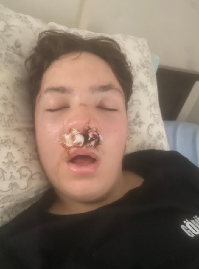 Bursa'da lise çıkışında kavga! 14 yaşındaki gencin burnu kırıldı