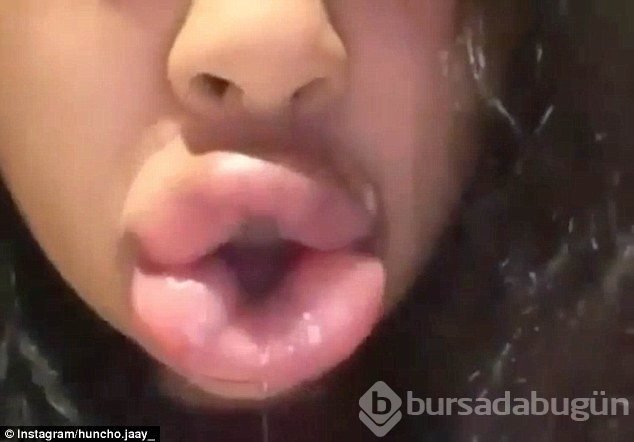 Dudak dolgunlaştırmada son nokta