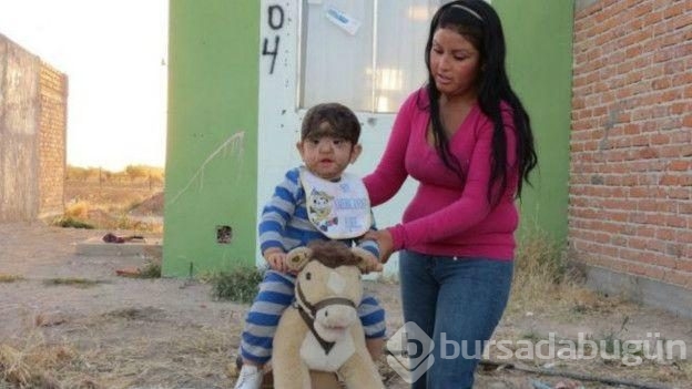 Bütün aile hipertrikoz hastası