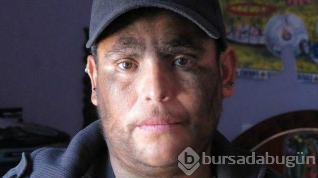 Bütün aile hipertrikoz hastası