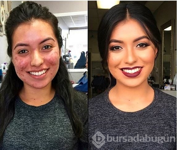 O sivilceleri gizlemenin yöntemini bulmuş