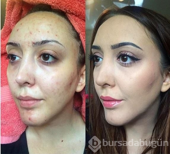 O sivilceleri gizlemenin yöntemini bulmuş