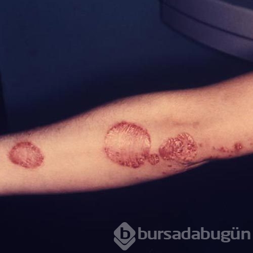 Sedef hastalığının belirtileri ve tedavisi