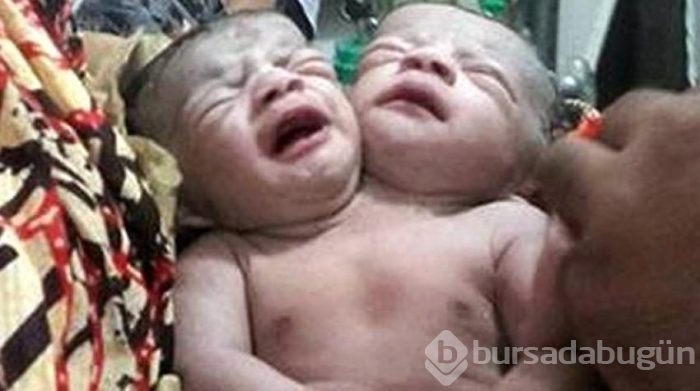 İki başlı mucize bebek