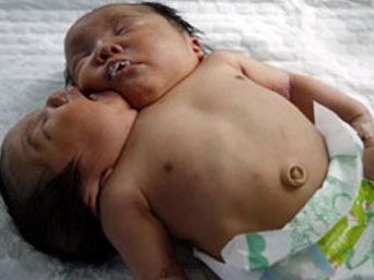 İki başlı mucize bebek