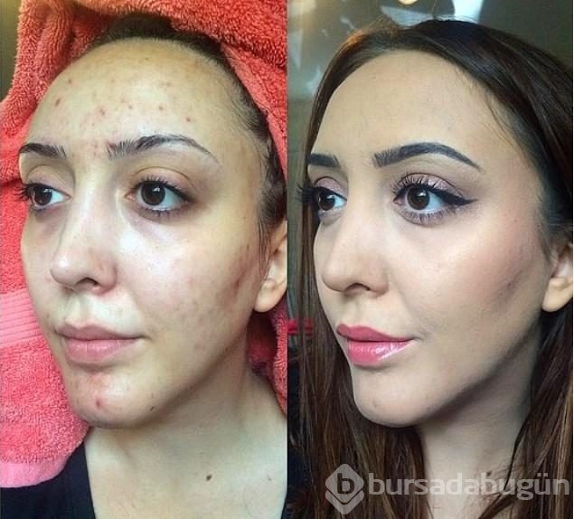 Makyajla sivicelerine veda eden kadınlar