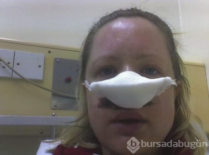 O bakteri burun kemiğini düşürdü!