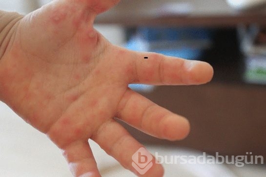 Okullardaki yeni salgın el ayak hastalığı	
