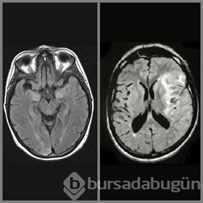 Okullardaki yeni salgın el ayak hastalığı	
