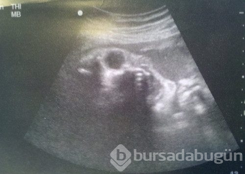 Ultrasonda şok oldular!
