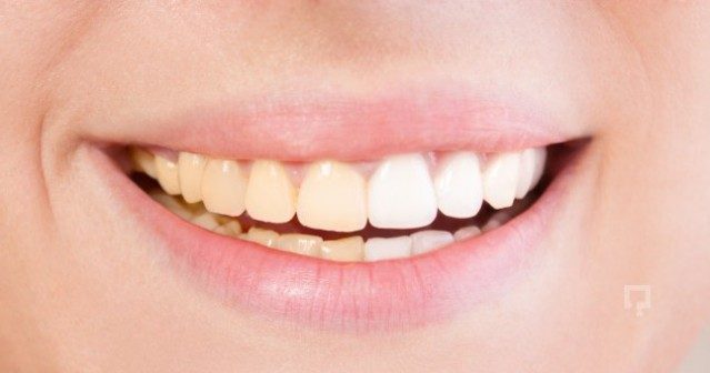 Bunu yapın dişlerinizin sararmasını engelleyin
