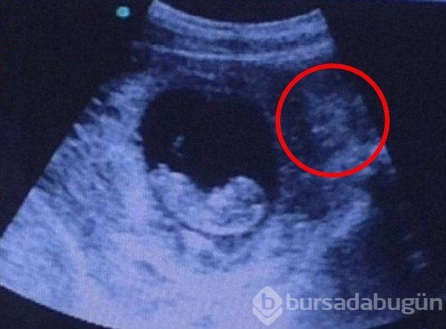 Ultrasonda korkutan görüntü!