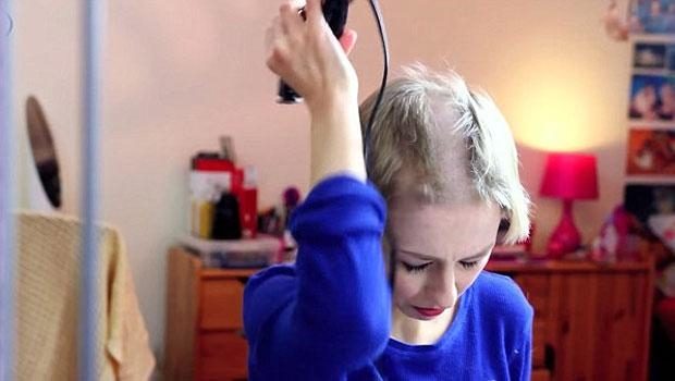 Trikotillomani yüzünden saçlarını kazımak zorunda kaldı