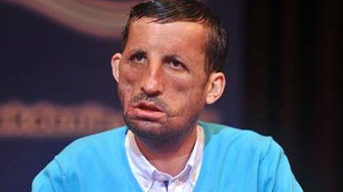 İlk yüz nakilli Uğur Acar hastaneye kaldırıldı	
