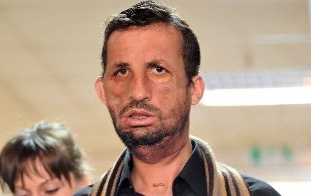 İlk yüz nakilli Uğur Acar hastaneye kaldırıldı	
