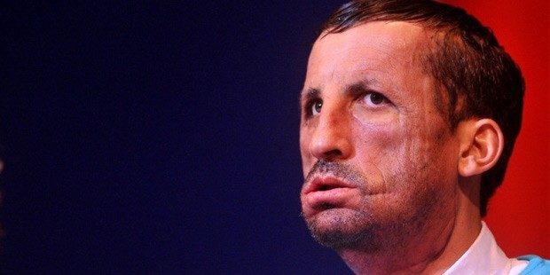 İlk yüz nakilli Uğur Acar hastaneye kaldırıldı	
