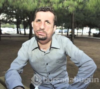 İlk yüz nakilli Uğur Acar hastaneye kaldırıldı	
