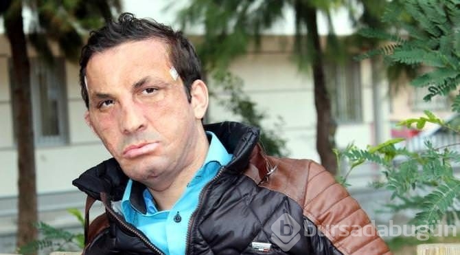 İlk yüz nakilli Uğur Acar hastaneye kaldırıldı	
