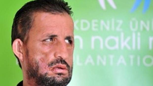 İlk yüz nakilli Uğur Acar hastaneye kaldırıldı	
