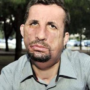 İlk yüz nakilli Uğur Acar hastaneye kaldırıldı	
