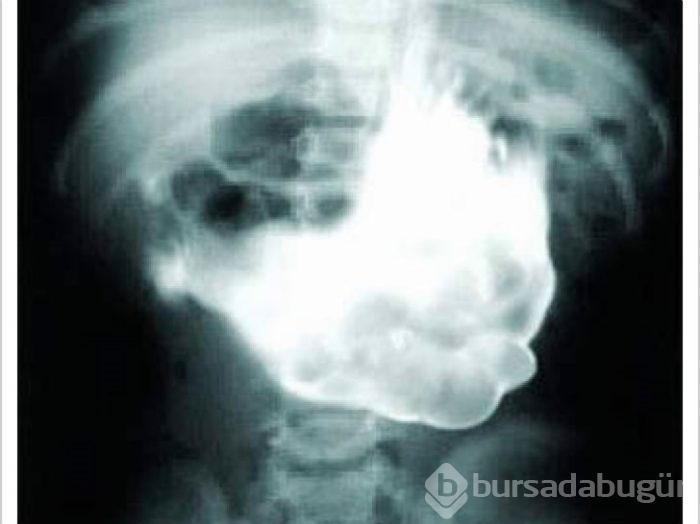 İnsan midesinden çıkartılan en korkunç şeyler