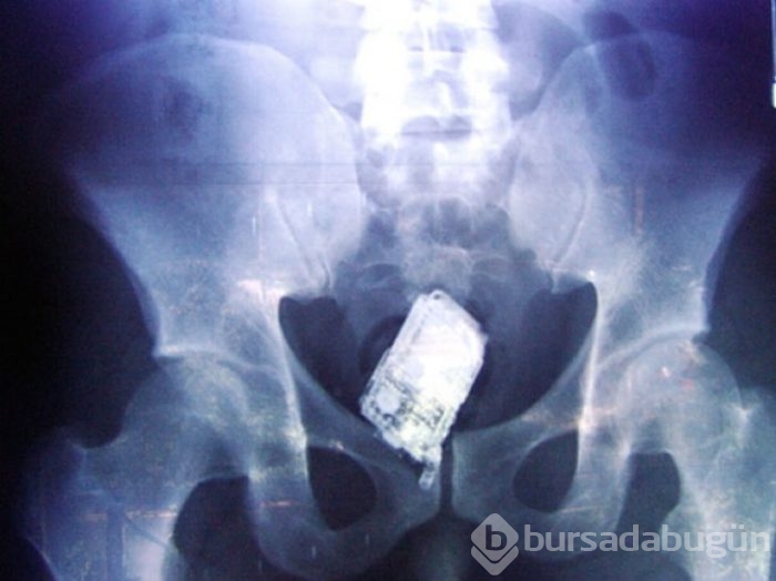 İnsan midesinden çıkartılan en korkunç şeyler