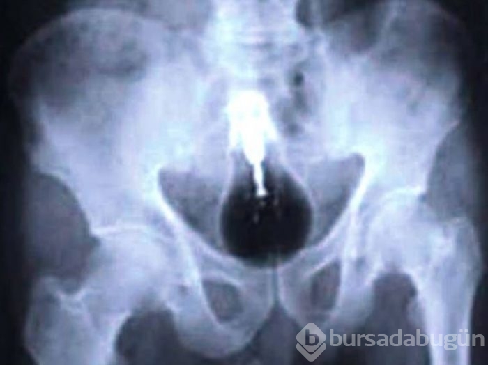 İnsan midesinden çıkartılan en korkunç şeyler