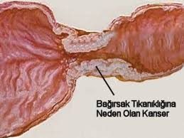 Hemoroid mi? Bağırsak kanseri mi?