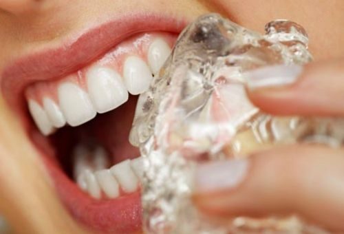 Bonding nedir?