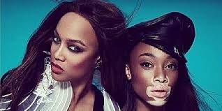 Vitiligo hastası manken güzelliğiyle büyülüyor