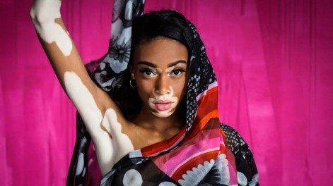 Vitiligo hastası manken güzelliğiyle büyülüyor