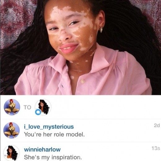 Vitiligo hastası manken güzelliğiyle büyülüyor