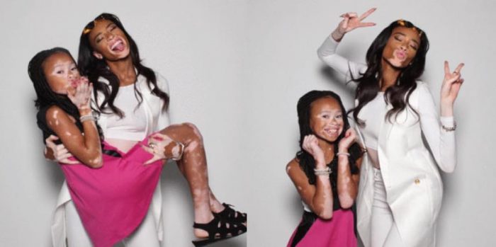 Vitiligo hastası manken güzelliğiyle büyülüyor