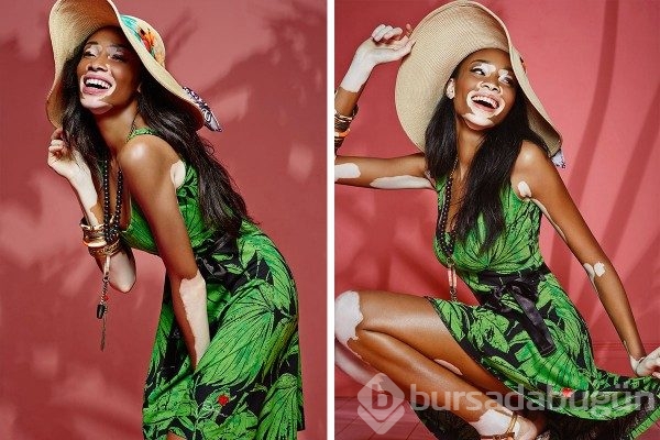 Vitiligo hastası manken güzelliğiyle büyülüyor